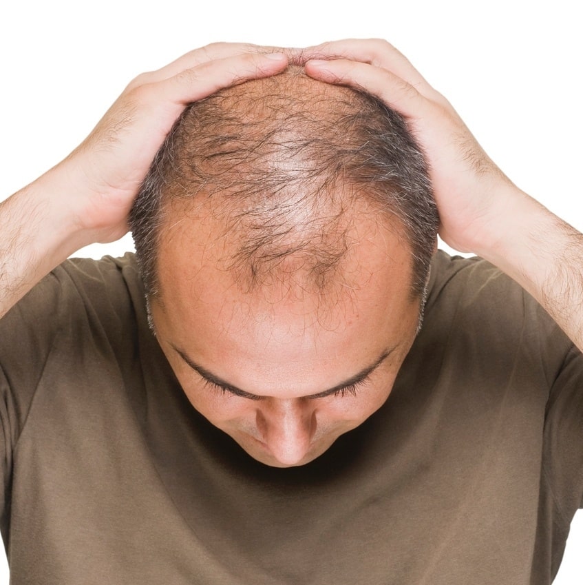 Does baldness bother you?